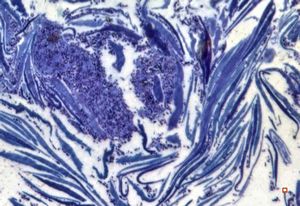 M, 57y. | dermal mycotic lesion … toluidine-blue stained semithin section